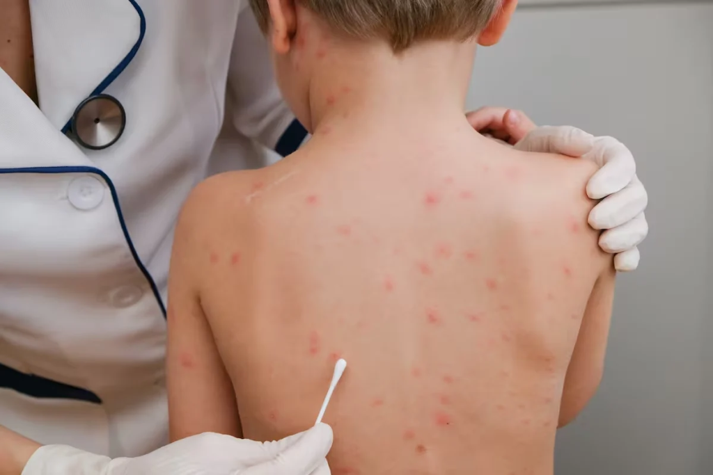 Alerta por sarampión en AMBA y predominio de Influenza A en infecciones respiratorias 2 image 2